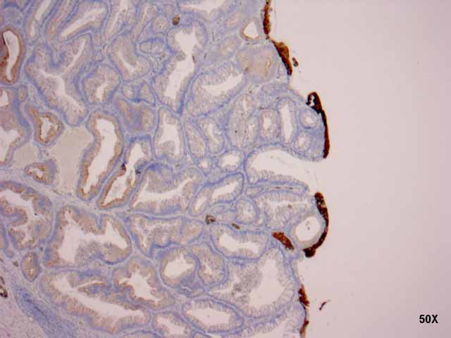 Figura 3 - Restos de urotelio en superficie del adenoma con citoqueratina 7.